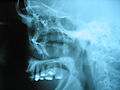 Imagen de rayos x en escala de grises de un cráneo humano. Esta radiografía cephalametric lateral izquierdo muestra un perfil del cráneo humano. El maxilar y algunos dientes coronados constituyen la mayor parte de la imagen. Por encima de que cuatro uñas débiles como las estructuras son visibles.