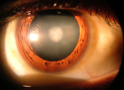 La cataracte dans eye.png humaine