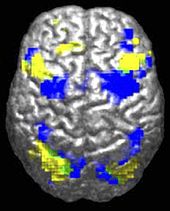 Um cérebro humano visto de cima. Cerca de 10% é destacada em amarelo e 10% em azul. Existe apenas uma pequena (talvez 0,5%) região verde, onde eles se sobrepõem.