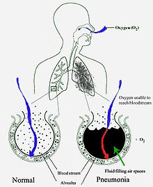 Um diagrama esquemático dos pulmões humanos, com um círculo vazio à direita representa um alveola normal e uma no lado direito mostrando uma alveola cheio de fluido como na pneumonia