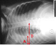 Um raio-X mostrando um peito deitado horizontal. A área inferior preta que é o pulmão direito é menor com uma área de mais brancos abaixo de um derrame pulmonar. Existem setas vermelhas que marcam o tamanho destes.
